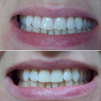 Peachtree Smile Center | Teeth Whitening, Dentures and Prophylaxis Cleanings