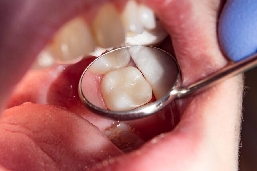 Different Types of Dental Fillings: Which One Is Right for You?