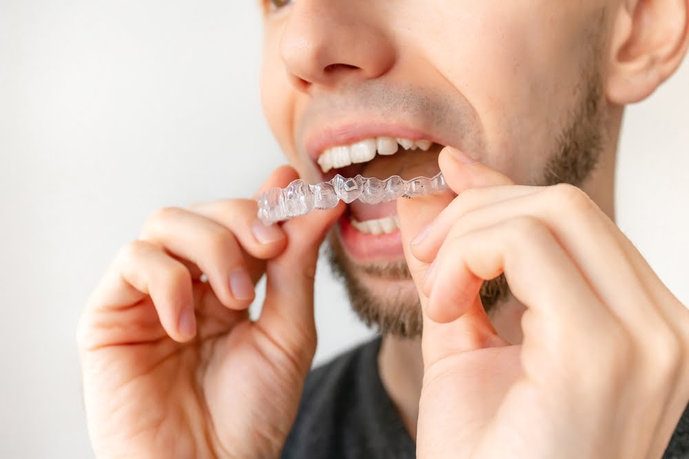 A man is placing a clear dental aligner over his teeth - Dentist Atlanta A man is placing a clear dental aligner over his teeth - Dentist Atlanta