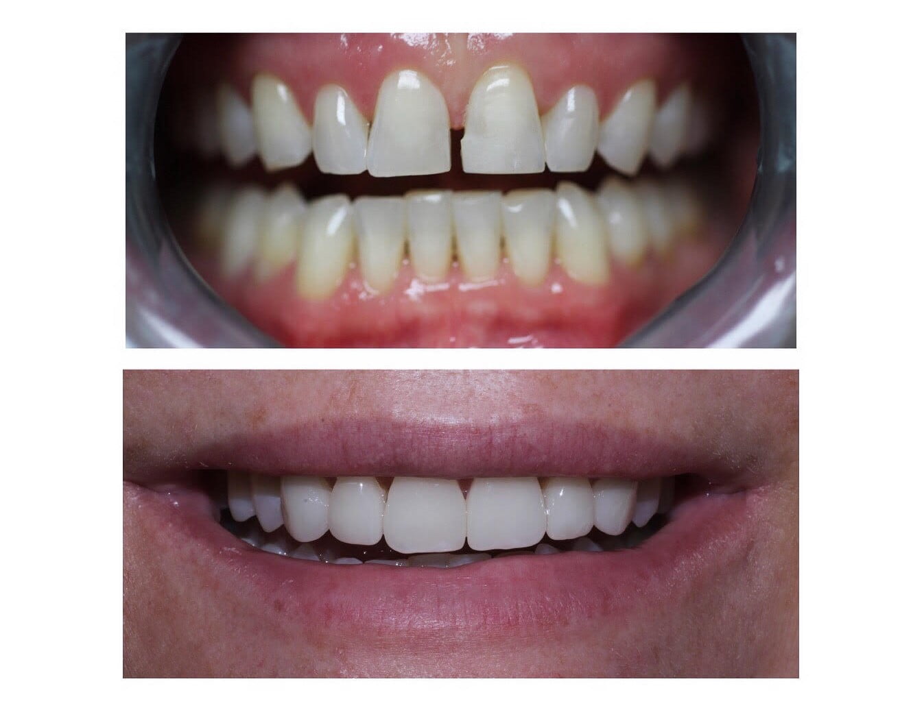 Before and After of Dental Veneers