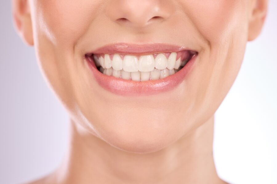 What is Dental Bonding? 5 Common Conditions Treated
