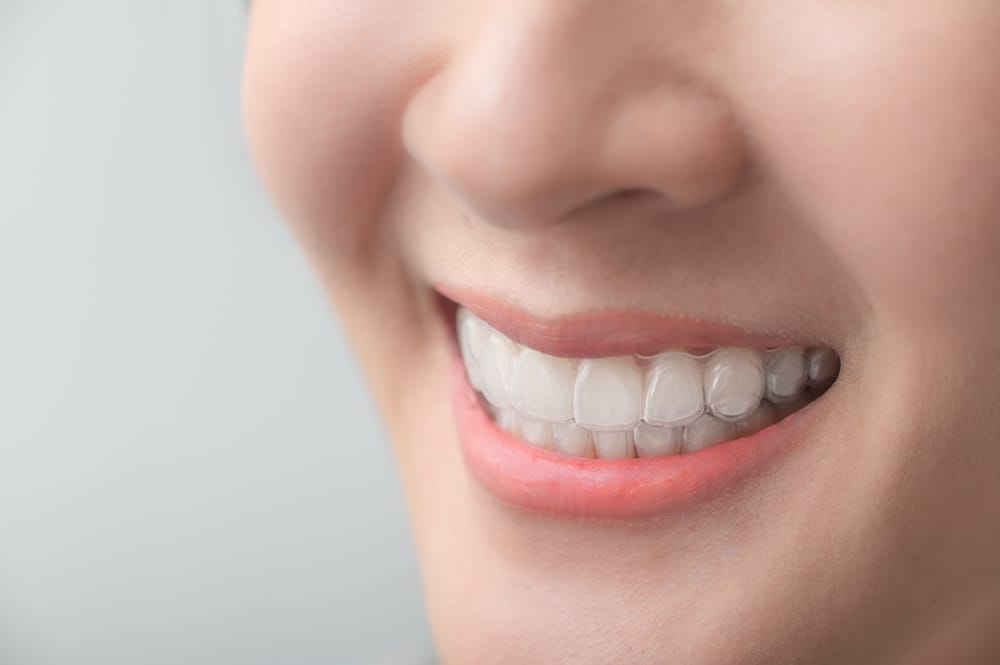 A man is placing a clear dental aligner over his teeth - Dentist Atlanta